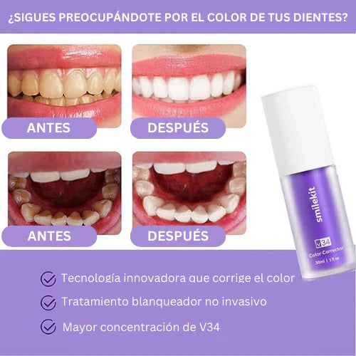 Ultra Blanqueamiento Dental 🦷